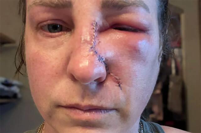Amanda Anderson'dan Şok Hikaye: Burnundaki Leke Cilt Kanseri Çıktı, Tüm Kamuoyunu Uyarıyor