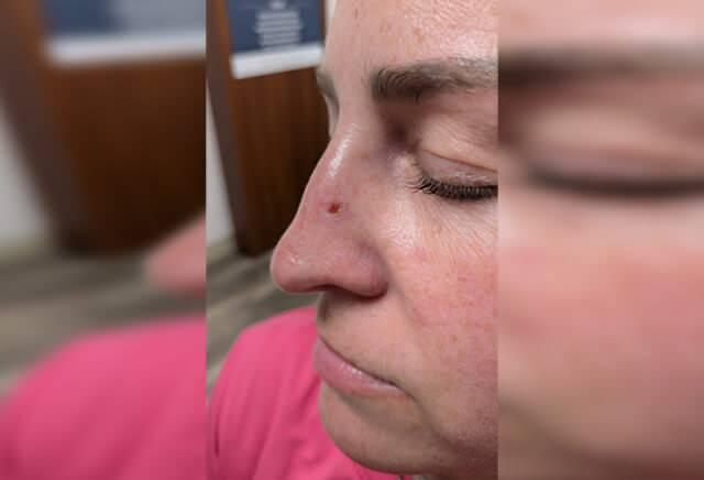Amanda Anderson'dan Şok Hikaye: Burnundaki Leke Cilt Kanseri Çıktı, Tüm Kamuoyunu Uyarıyor