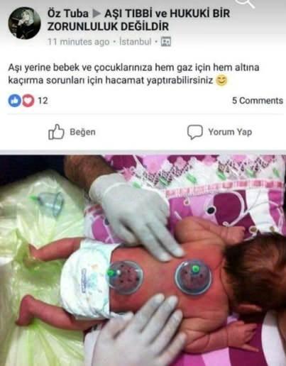 Bebeklere Hacamat Uygulaması Hakkında Uzmanlar Ne Diyor? Riskler ve Uyarılar