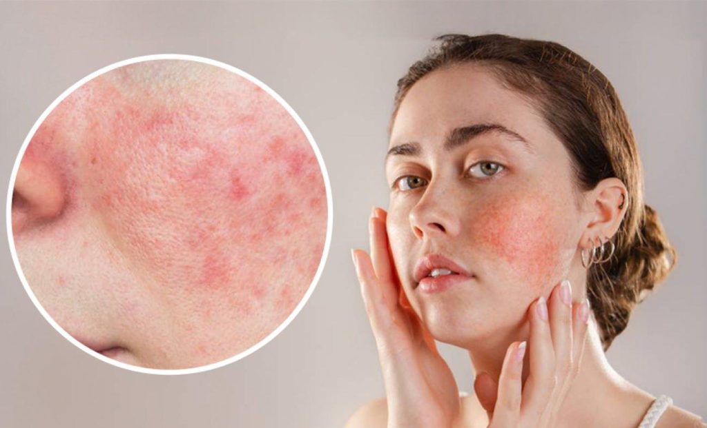 Dermatoloji Uzmanı Uyardı: Yüzdeki Kızarıklık ve Yanma, Gül Hastalığı Olabilir