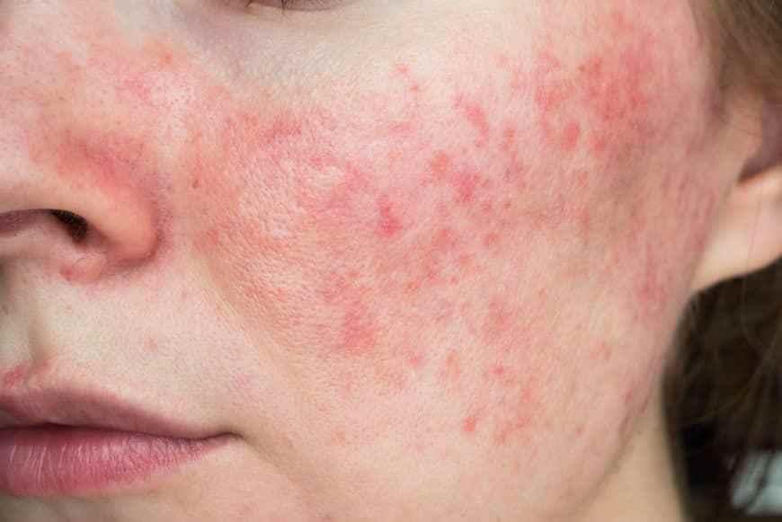 Dermatoloji Uzmanı Uyardı: Yüzdeki Kızarıklık ve Yanma, Gül Hastalığı Olabilir