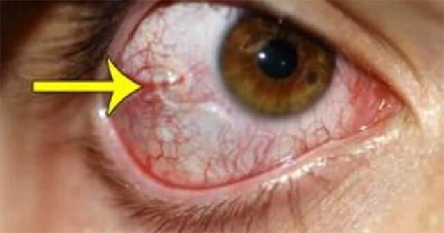 Gözde Solucan Tehlikesi: Nadir Parazit Gnathostoma spinigerum ve Vitrektomi Süreci