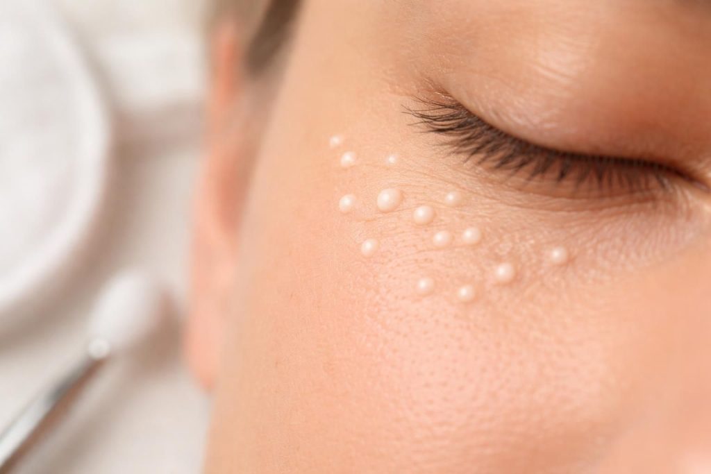 Milia ve Milium Nedir? Keratin Kistleri Hakkında Bilmeniz Gereken Her Şey