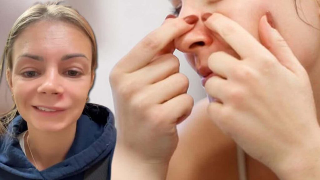 Sivilce Sıkmak Ölümcül Olabilir: Doktorların Uyarıda Bulunduğu ‘Ölüm Üçgeni’ Nedir?