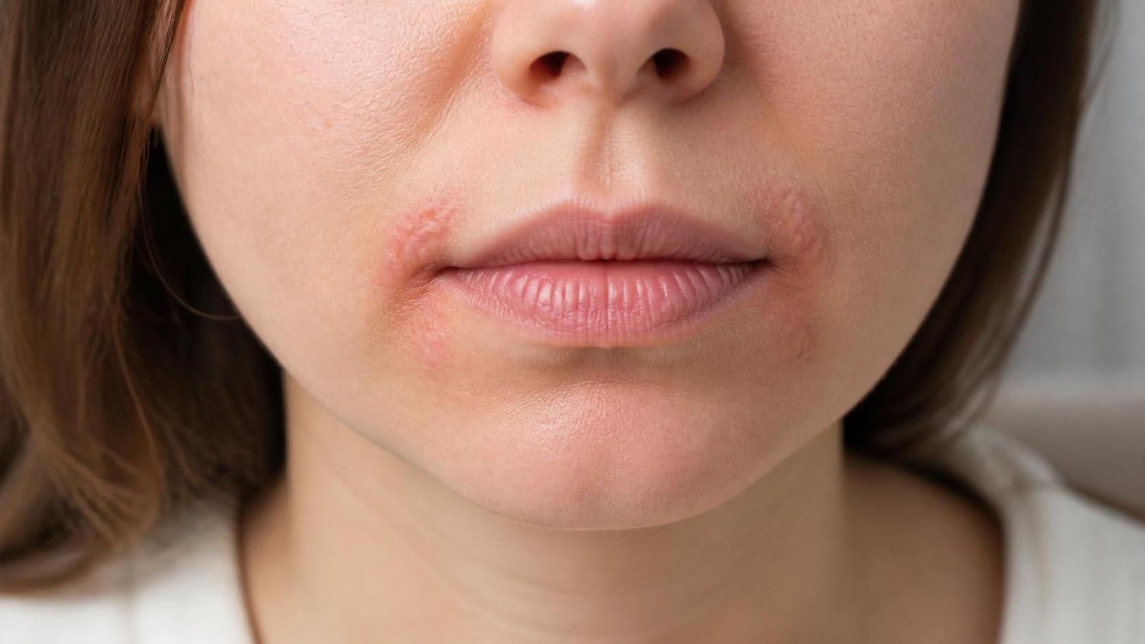 Dudak Kenarlarında Ağrılı Sivilceler: Perioral Dermatit Nedir, Neden Olur Ve Nasıl Tedavi Edilir?