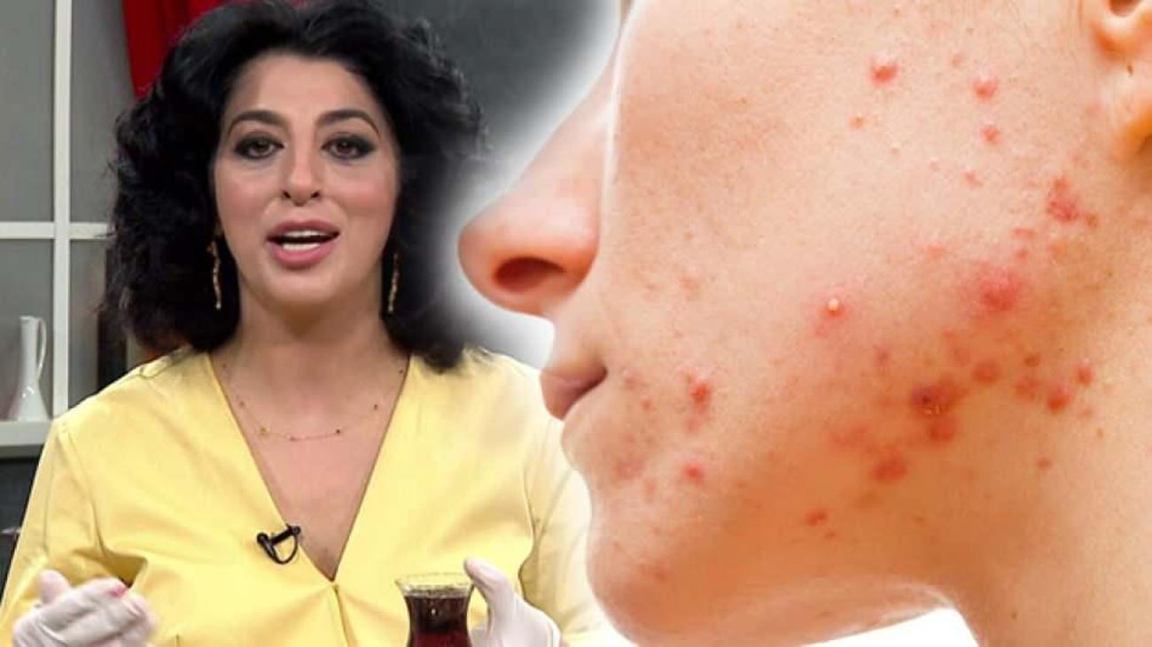Şems Arslan: Şems Aslan Sivilce Maskesi: Ergenlikten Regl Sivilcelerine Doğal Bakım Rutini